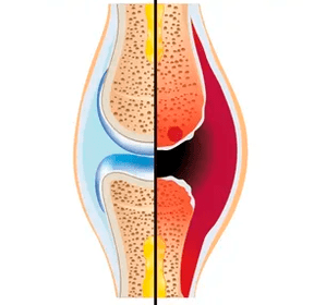 La structure d'une articulation saine et usée avec la désignation de tissu cartilagineux et de liquide synovial